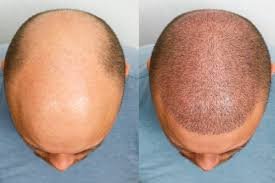 The Ultimate Guide to Hair Transplant in Dubai: Restore Your Confidence