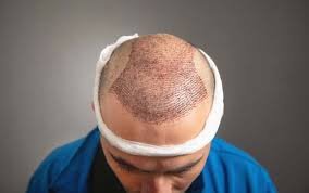 Things To Know Before Looking For The Best Hair Transplant in Delhi